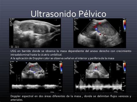 Tumor De Senos Endodérmicos