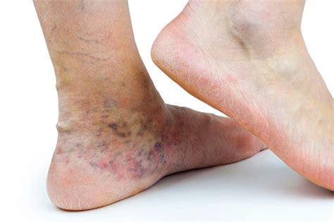 Venous Dermatitis Untreated Varicose Vein Complications Vein Health