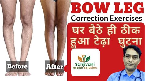 Bow Legs Correction Exercises Bow Leg Correction At Home How To Fix Bowed Legs Youtube