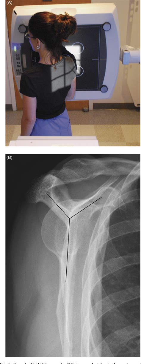 Figure 6 From Radiographic Evaluation Of The Shoulder Semantic Scholar