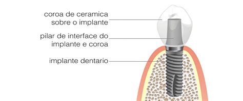 O que é um implante dentário quando e porquê optar por ele