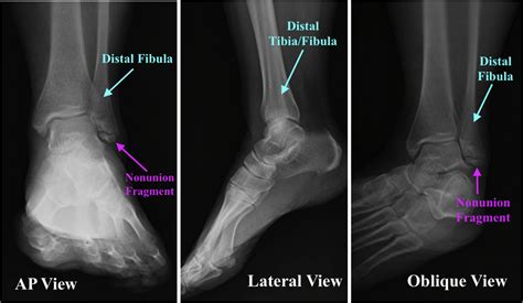 Single Knotless Suture Anchor Repair Of Anterior Talofibular Ligament