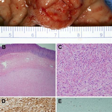 Endoscopic features of the gastric tumor. At the initial endoscopy a fi... | Download Scientific ...