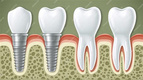 Premium Photo Comprehensive Guide Tooth Implant Conditions