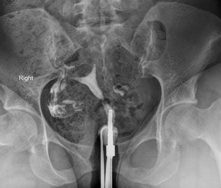 Arcuate uterus | Radiology Case | Radiopaedia.org