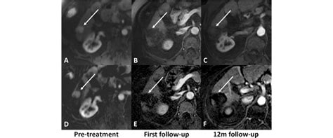 74-year-old female with NASH cirrhosis and right hepatic lobe HCC ...