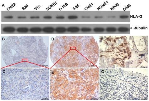 Expressions Of HLA G In NPC Cell Lines And NPC Tissues A The HLA G