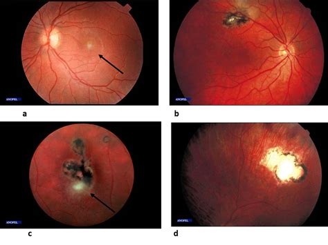 Risk Factors Pathogenesis And Diagnosis Of Ocular Toxoplasmosis