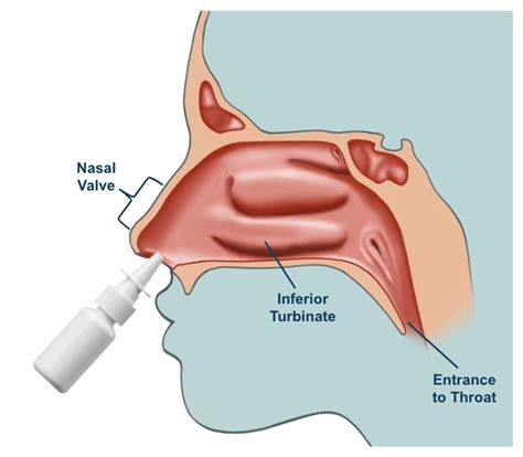 Drug Delivery Device — Nasus Medical