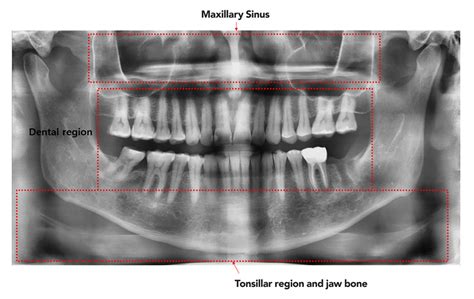 Detecting Dental Diseases With AI Dental Image Analysis