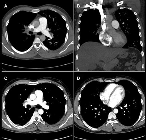 E A Ct Pulmonary Angiogram Demonstrating Thrombi In Right And Left Download Scientific Diagram