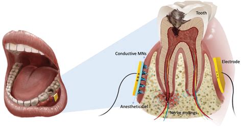 Schematic Diagram Demonstrating The Enhanced Effect Of Conductive Mns