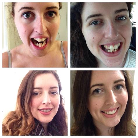 15 drastic transformations of people before and after braces