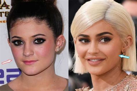 Kylie Jenner Before and after: Nose Job, Lip Injections, Breast