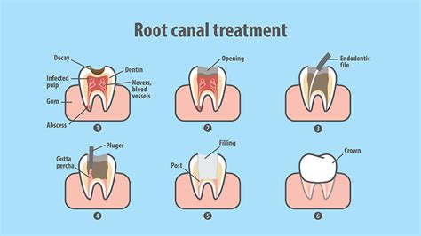 Root Canal Therapy | Dentists Serving Greater Detroit, MI