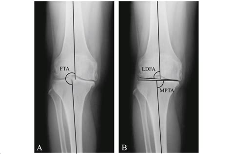 Radiographic measurement of femorotibial angle (FTA, a), medial ...