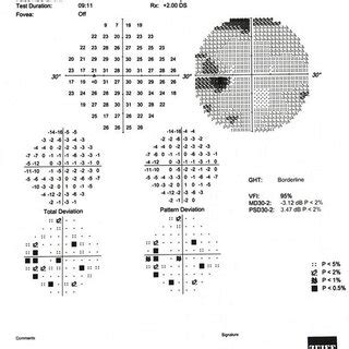 Visual field OS in September 2021: enlarged blind spot, decreased ...