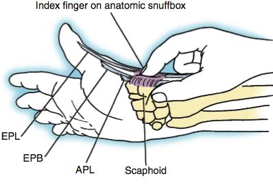 Scaphoid Fractures And Non Unions Handout Dr Thomas Trumble M D