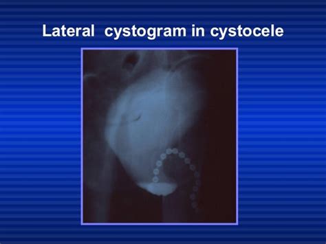 Modified extended anterior vaginal wall repair for cystocele