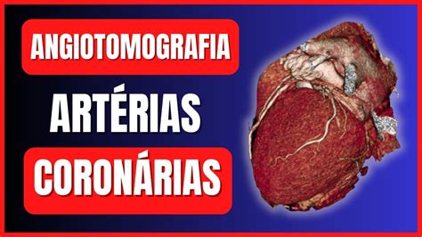 COMO É FEITO O EXAME DE ANGIOTOMOGRAFIA DAS ARTÉRIAS CORONÁRIAS