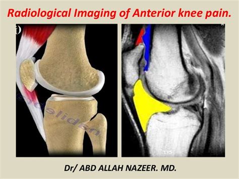 Patellofemoral Pain Syndrome Mri Quotes Trendy New