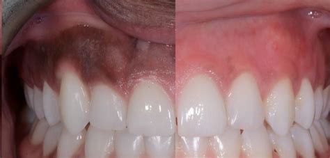 Laser Gum Treatment Normanhurst Dental