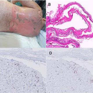 A Clinical Image Of Patient Two B Hematoxylin Eosin On A Biopsy Of