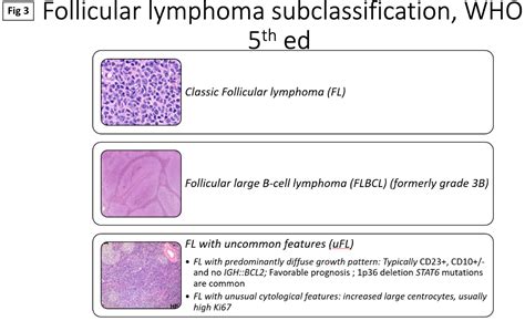 Case Study Diagnosis Classification And Treatment Of Follicular