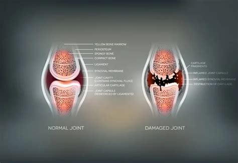 20 Diarthrosis Vector Images, Diarthrosis Illustrations | Depositphotos