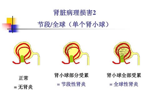 肾小球疾病概述word文档在线阅读与下载无忧文档