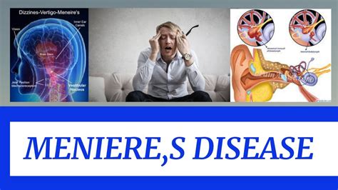 MENIERES DISEASE YouTube