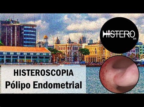 Histeroscopia Cirúrgica para Polipectomia Pólipo Endometrial YouTube