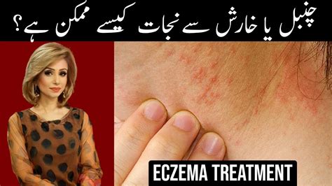 Chambal Ka Llaj Eczema Ka Ilaj How To Treat Eczema Eczema