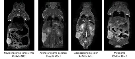 PDMR TEXTURE ANALYSIS The Cancer Imaging Archive TCIA