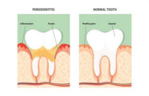 What Are Periodontal Pockets: Can It Be Reversed?