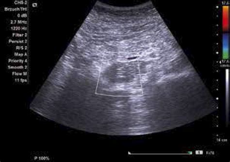 Abdominal Ultrasonography A Homogeneous Hypoechoic Mass Of 45 Mm Download Scientific Diagram