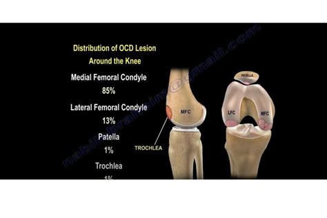 Osteochondritis Dissecans Of The Knee — OrthopaedicPrinciples.com