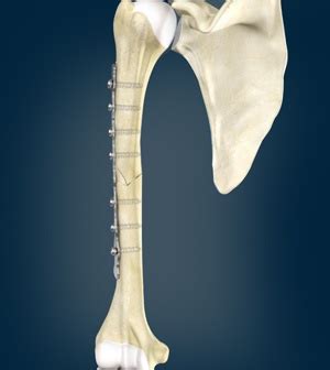 Humerus Fracture Irving, TX | Open Reduction and Internal Fixation ...