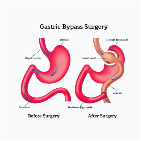 Gastric Sleeve Gastric Bypass