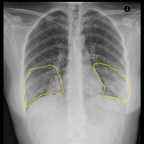 Mycoplasma Pneumonia Differential Diagnosis Wikidoc