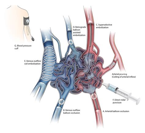 Peripheral Arteriovenous Malformations Classification And Endovascular Treatment Applied