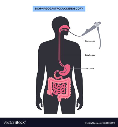 Esophagogastroduodenoscopy Medical Procedure Vector Image