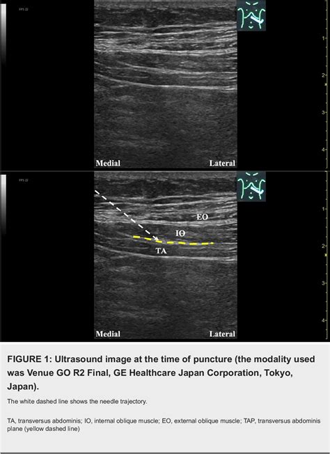 Figure 1 From A Case Report On Abdominal Pain Treated With A New Technique Of Ultrasound Guided