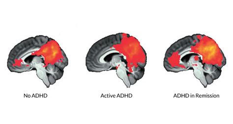 Brain signal reappears after ADHD symptoms fade