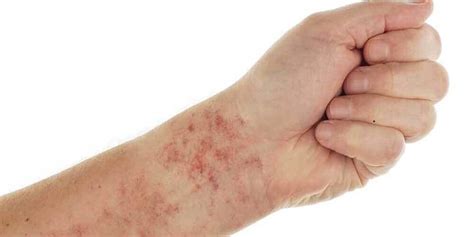 When Does a Chlamydia Skin Rash Occur? - Flash Uganda Media