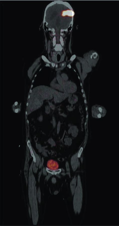 Whole Body Pet Ct Scan Shows Biodistribution Minutes After