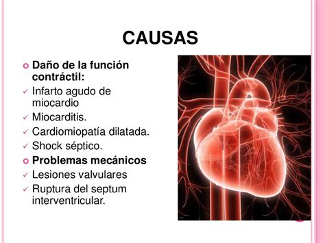 Shock Cardiogenico