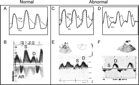 Preliminary Experience With Combined Inhaled Milrinone And Prostacyclin