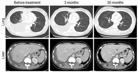 Structurally Rare Eml4 Alk Identified By Next Generation Sequencing In