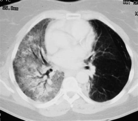 Radiation Therapy: Recovery After Radiation Therapy